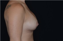 Breast Augmentation After Photo by Landon Pryor, MD, FACS; Rockford, IL - Case 37701
