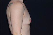 Breast Augmentation Before Photo by Landon Pryor, MD, FACS; Rockford, IL - Case 37701