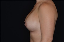 Breast Augmentation After Photo by Landon Pryor, MD, FACS; Rockford, IL - Case 37701