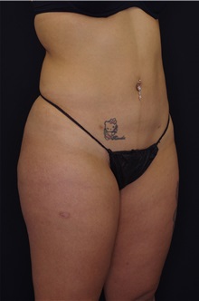 Body Contouring After Photo by Landon Pryor, MD, FACS; Rockford, IL - Case 37702