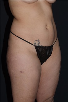 Body Contouring Before Photo by Landon Pryor, MD, FACS; Rockford, IL - Case 37702