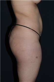 Body Contouring Before Photo by Landon Pryor, MD, FACS; Rockford, IL - Case 37702