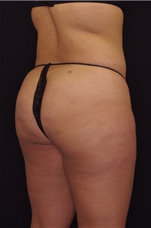 Body Contouring After Photo by Landon Pryor, MD, FACS; Rockford, IL - Case 37702