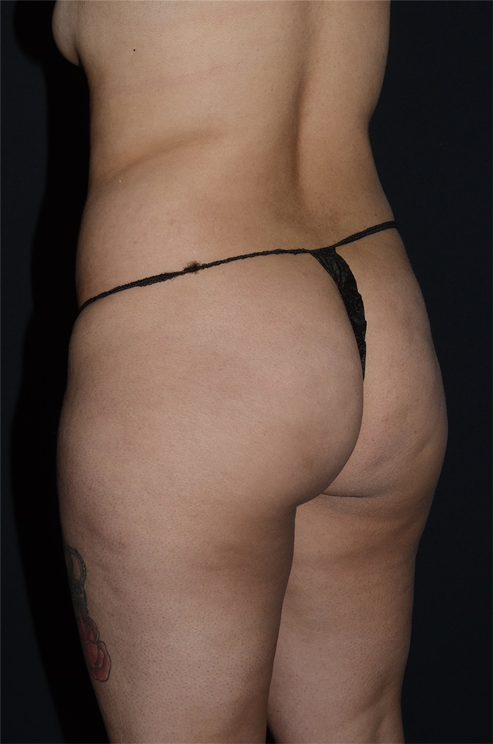 Body Contouring Before and After Photos by Landon Pryor, MD, FACS; Rockford, IL photo picture