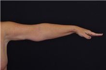 Arm Lift After Photo by Landon Pryor, MD, FACS; Rockford, IL - Case 37703