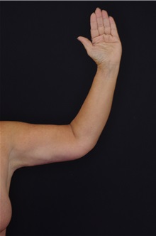 Arm Lift After Photo by Landon Pryor, MD, FACS; Rockford, IL - Case 37703