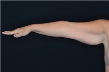 Arm Lift Before Photo by Landon Pryor, MD, FACS; Rockford, IL - Case 37703