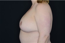 Breast Reduction After Photo by Landon Pryor, MD, FACS; Rockford, IL - Case 37704