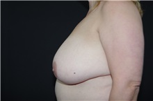Breast Reduction Before Photo by Landon Pryor, MD, FACS; Rockford, IL - Case 37704