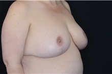 Breast Reduction After Photo by Landon Pryor, MD, FACS; Rockford, IL - Case 37704