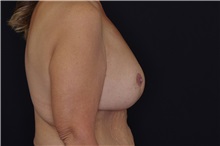 Breast Reduction After Photo by Landon Pryor, MD, FACS; Rockford, IL - Case 37713