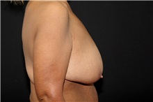 Breast Reduction Before Photo by Landon Pryor, MD, FACS; Rockford, IL - Case 37713