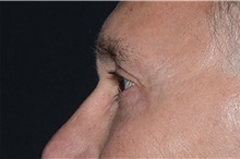 Eyelid Surgery After Photo by Landon Pryor, MD, FACS; Rockford, IL - Case 37714
