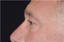 Eyelid Surgery Before Photo by Landon Pryor, MD, FACS; Rockford, IL - Case 37714