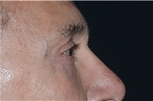 Eyelid Surgery After Photo by Landon Pryor, MD, FACS; Rockford, IL - Case 37714