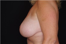Breast Reduction After Photo by Landon Pryor, MD, FACS; Rockford, IL - Case 37724
