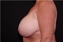 Breast Reduction Before Photo by Landon Pryor, MD, FACS; Rockford, IL - Case 37724