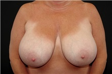 Breast Reduction Before Photo by Landon Pryor, MD, FACS; Rockford, IL - Case 37735
