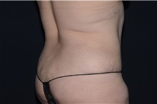 Tummy Tuck After Photo by Landon Pryor, MD, FACS; Rockford, IL - Case 37736