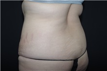 Tummy Tuck Before Photo by Landon Pryor, MD, FACS; Rockford, IL - Case 37736