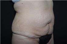 Tummy Tuck Before Photo by Landon Pryor, MD, FACS; Rockford, IL - Case 37736