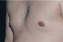 Male Breast Reduction After Photo by Landon Pryor, MD, FACS; Rockford, IL - Case 37737