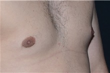 Male Breast Reduction After Photo by Landon Pryor, MD, FACS; Rockford, IL - Case 37737