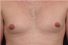 Male Breast Reduction Before Photo by Landon Pryor, MD, FACS; Rockford, IL - Case 37737