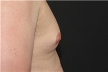 Male Breast Reduction Before Photo by Landon Pryor, MD, FACS; Rockford, IL - Case 37737