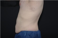 Tummy Tuck Before Photo by Landon Pryor, MD, FACS; Rockford, IL - Case 37759