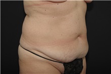 Tummy Tuck Before Photo by Landon Pryor, MD, FACS; Rockford, IL - Case 37777