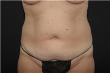 Tummy Tuck Before Photo by Landon Pryor, MD, FACS; Rockford, IL - Case 37777