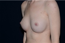 Breast Augmentation After Photo by Landon Pryor, MD, FACS; Rockford, IL - Case 37806