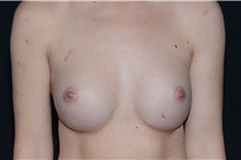Breast Augmentation After Photo by Landon Pryor, MD, FACS; Rockford, IL - Case 37806