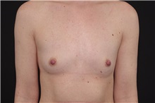 Breast Augmentation Before Photo by Landon Pryor, MD, FACS; Rockford, IL - Case 37806