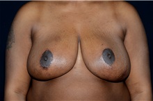 Breast Reduction After Photo by Landon Pryor, MD, FACS; Rockford, IL - Case 37838
