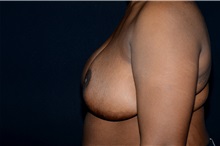 Breast Reduction After Photo by Landon Pryor, MD, FACS; Rockford, IL - Case 37838