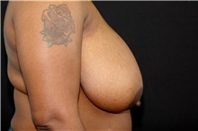 Breast Reduction Before Photo by Landon Pryor, MD, FACS; Rockford, IL - Case 37838