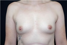 Breast Augmentation Before Photo by Landon Pryor, MD, FACS; Rockford, IL - Case 37865