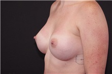Breast Augmentation After Photo by Landon Pryor, MD, FACS; Rockford, IL - Case 37865