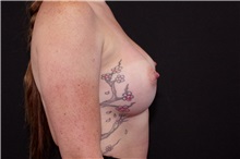 Breast Augmentation After Photo by Landon Pryor, MD, FACS; Rockford, IL - Case 37865