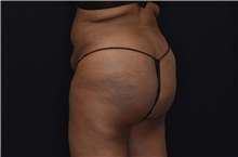 Buttock Lift with Augmentation After Photo by Landon Pryor, MD, FACS; Rockford, IL - Case 37949