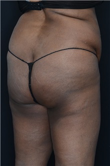 Buttock Lift with Augmentation Before Photo by Landon Pryor, MD, FACS; Rockford, IL - Case 37949