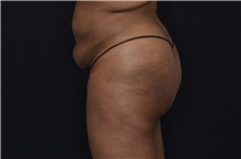 Buttock Lift with Augmentation After Photo by Landon Pryor, MD, FACS; Rockford, IL - Case 37949
