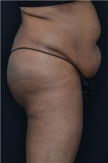 Buttock Lift with Augmentation Before Photo by Landon Pryor, MD, FACS; Rockford, IL - Case 37949