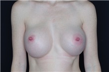 Breast Augmentation After Photo by Landon Pryor, MD, FACS; Rockford, IL - Case 37951