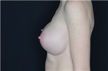 Breast Augmentation After Photo by Landon Pryor, MD, FACS; Rockford, IL - Case 37951