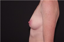 Breast Augmentation Before Photo by Landon Pryor, MD, FACS; Rockford, IL - Case 37951