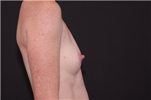 Breast Augmentation Before Photo by Landon Pryor, MD, FACS; Rockford, IL - Case 37951