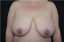 Breast Reduction Before Photo by Landon Pryor, MD, FACS; Rockford, IL - Case 37954